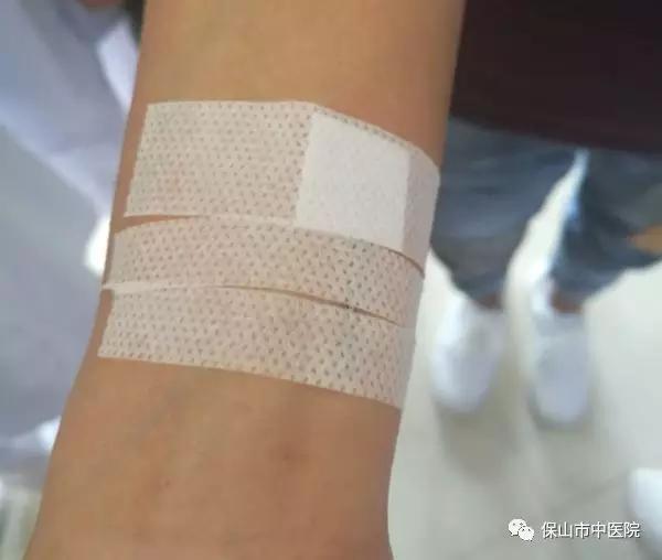 美小护以身试针助力新技术“腕踝针”示教培训(图4) 美小护以身试针助力新技术“腕踝针”示教培训(图4)