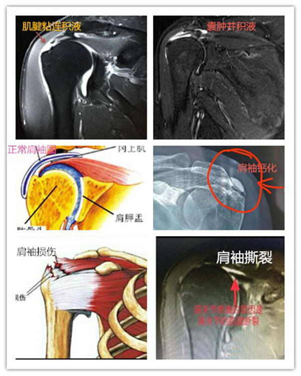 肩关节反复疼痛不要急,精准治疗解难题(图1) 肩关节反复疼痛不要急,精准治疗解难题(图1)