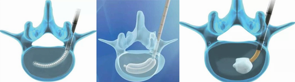 治疗椎体压缩骨折—保山市中医医成功开展西南地区第一台SPKP手术(图3) 治疗椎体压缩骨折—保山市中医医成功开展西南地区第一台SPKP手术(图3)