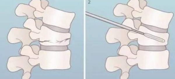 治疗椎体压缩骨折—保山市中医医成功开展西南地区第一台SPKP手术(图4) 治疗椎体压缩骨折—保山市中医医成功开展西南地区第一台SPKP手术(图4)