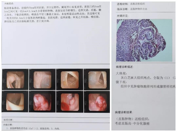 保山市中医医院外一科完成一例超低位直肠癌极限保肛术(图2) 保山市中医医院外一科完成一例超低位直肠癌极限保肛术(图2)