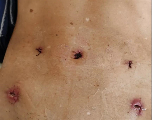 保山市中医医院外一科完成一例超低位直肠癌极限保肛术(图3) 保山市中医医院外一科完成一例超低位直肠癌极限保肛术(图3)